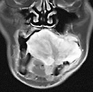 図2 a:造影MRI(T1/Gd-MRI)では、腫瘤全体に造影効果が認められ、とくに辺縁で著明であった