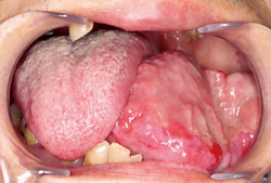 図1 口腔腫瘤。左側下顎歯肉に65×45mmの有茎性腫瘤が認められたが、基部は歯肉に限局しており、周囲組織への進展は認められなかった