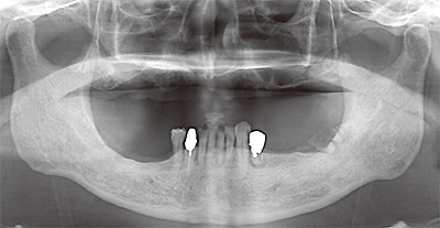 下唇部の知覚鈍麻 17 2月号1ques 診断力てすと Dental Diamond デンタルダイヤモンド 下唇部の知覚鈍麻 17 2月号1ques 診断力てすと Dental Diamond デンタルダイヤモンド
