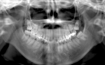 左側下顎部の激痛 17 5月号1ques 診断力てすと Dental Diamond デンタルダイヤモンド 左側下顎部の激痛 17 5月号1ques 診断力てすと Dental Diamond デンタルダイヤモンド