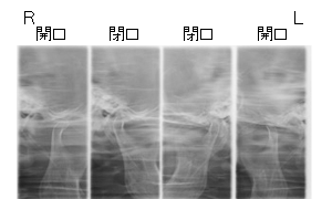 図2 TMJパノラマ断層写真