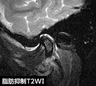 図1 初診時のMR画像(左側顎関節部矢状断)