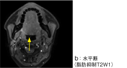 図3 a、b MRI画像