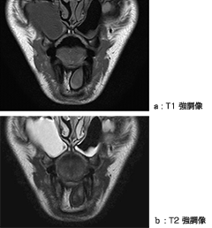>図3 MRI像(冠状断)