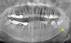 下顎埋伏智歯周囲の病変 18 5月号2ques 診断力てすと Dental Diamond デンタルダイヤモンド 下顎埋伏智歯周囲の病変 18 5月号2ques 診断力てすと Dental Diamond デンタルダイヤモンド