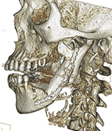 図3 摘出した腫瘤と黄白色の割面