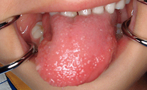 舌 の 横 が 腫れる