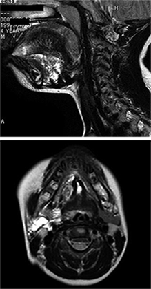 >図2 MRI T2強調画像