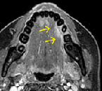 b:造影MRI(T1/Gd-MRI)。