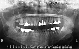 図2 初診時のパノラマX線写真。パノラマX線所見では顎骨病変を示唆する所見は認められなかった