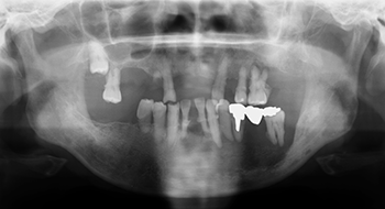 図2 初診時のパノラマX線写真