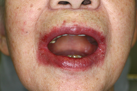 腫れ 画像 唇 唇が腫れる：医師が考える原因と対処法｜症状辞典