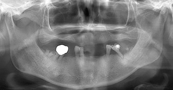 図2 初診時のパノラマX線写真