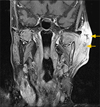図2 MRI(造影T1強調像)。矢印:不均一に造影されている中に造影されていない部位を含む病変