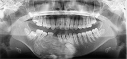 図3 初診時のパノラマX線写真