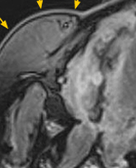 図3 同、造影MRI