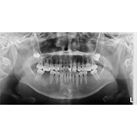 図2 初診時のパノラマX線写真