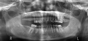 図1 初診時パノラマX線写真